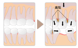 歯がないと、どうなるの？