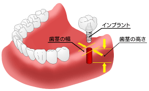 インプラント治療の注意点