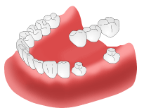 当院でのブリッジ治療について