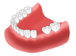 1次手術（インプラント埋入手術 ） 