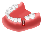 1次手術（インプラント埋入手術 ） 