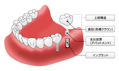 インプラント料金