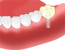 インプラント治療