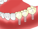 イメージ：インプラント 