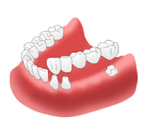 【ブリッジ治療】長所と短所