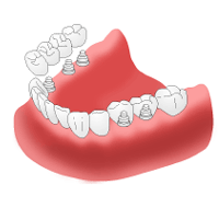 【インプラント治療】長所と短所